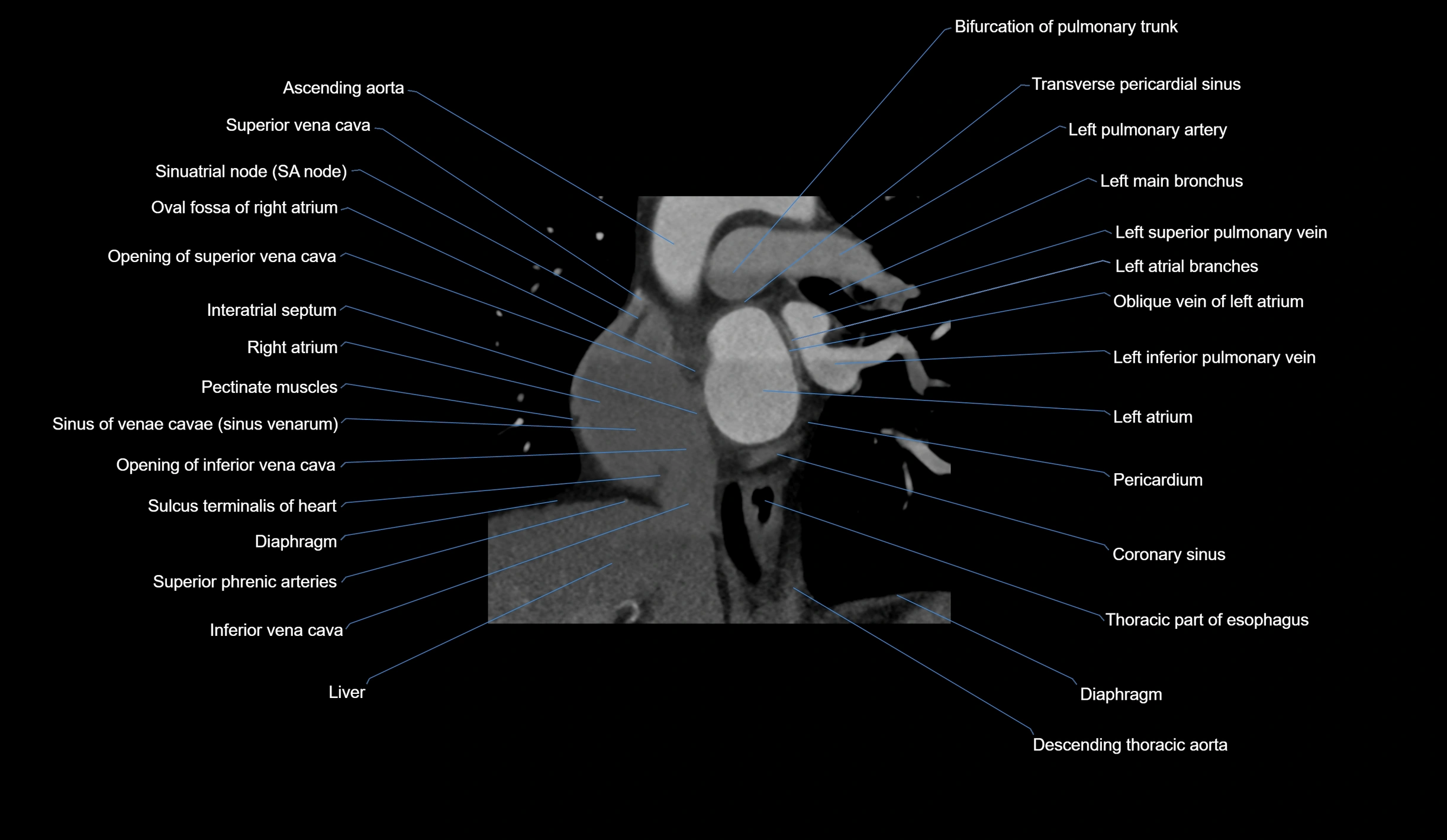 CT heart (coronary angiogram) short axis view  cross sectional anatomy labelled radiology image-00014.webp